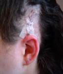 No more bandage